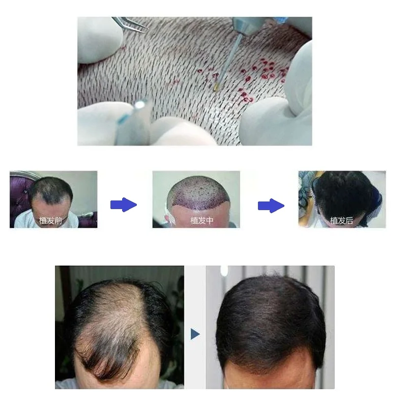 FUE lasnega mešička Extractor Scarless Hairless Zdravljenje Vsajene Lase Sajenje Las, Obrvi Ličila Orodja Plastičnih VL-MH81 4