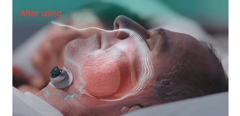 Smart Smrčijo Zamašek Anti Smrčijo ronco Rešitev udobno anti Smrčanje Biosensor z APP in spanje apnea monitor CPAP replacer 5